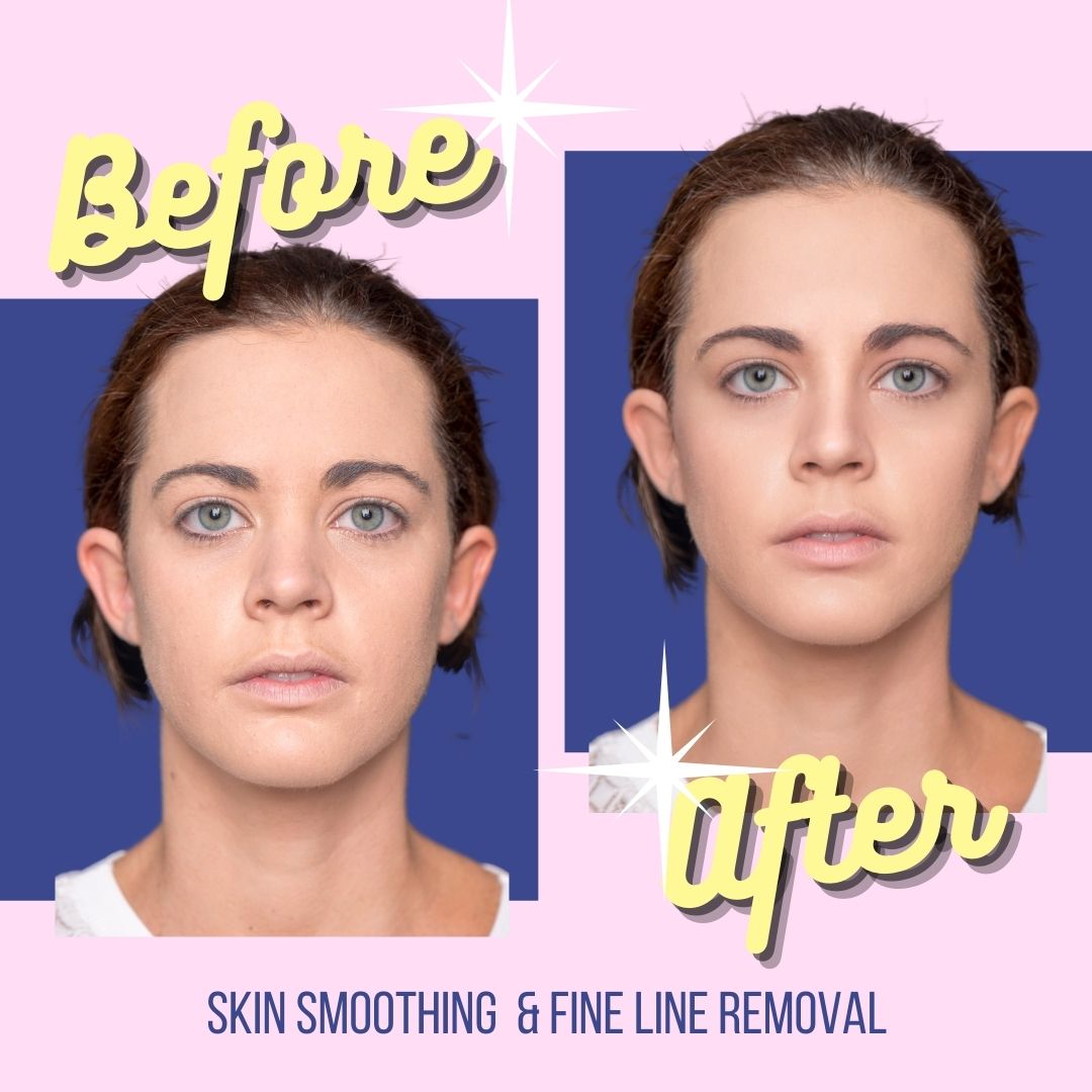Skin smoothing and fine line removal photo editing